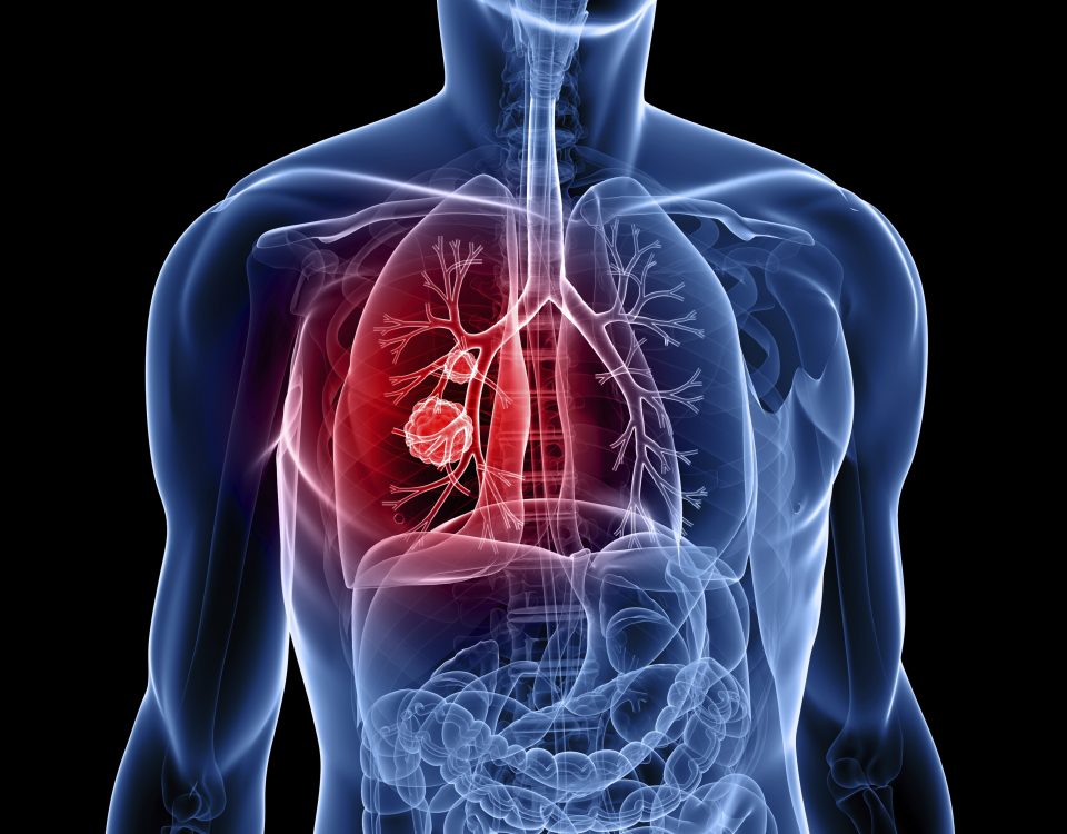 tractament cancer de pulmo